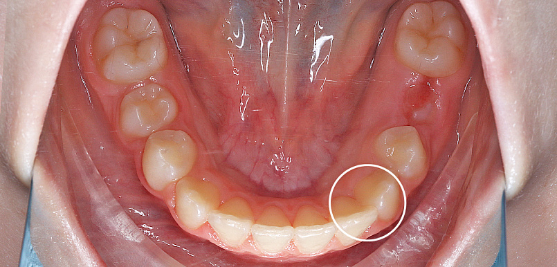 Ортодонтическое лечение на флексилайнерах