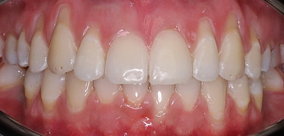 Ортодонтическое лечение неправильного положения зубов и челюстей