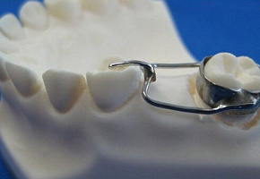 Для чего нужно ортодонтическое кольцо?