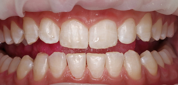 Зубной налет и зубной камень-в чем разница?