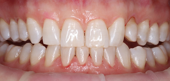 Зачем профгигиену делать перед лечением зубов?