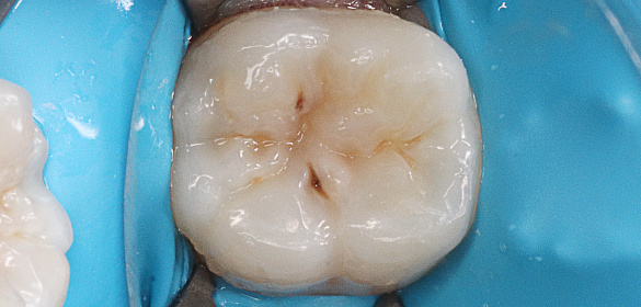 Лечение кариеса 36 зуба