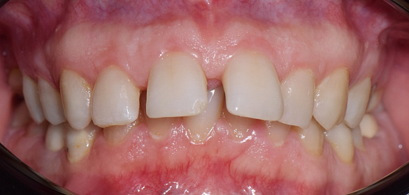 Ортодонтическое лечение  на брекет-системе