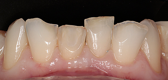 Восстановление при патологической стираемости зубов