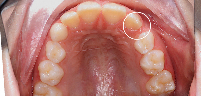 Ортодонтическое лечение на флексилайнерах